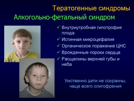Феталалкогольный синдром