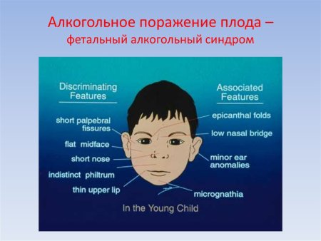 Fas фетальный алкогольный синдром