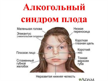 Фетальный алкогольный синдром