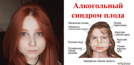 ФАС алкогольный синдром Водянова