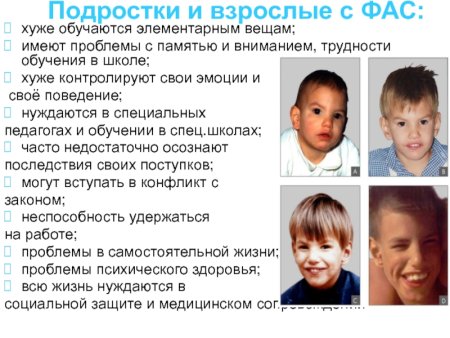 ФАС фетальный алкогольный синдром