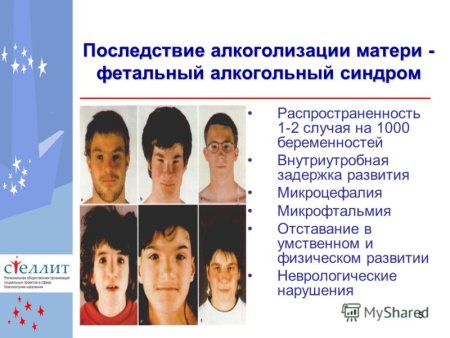 Алкогольный синдром плода