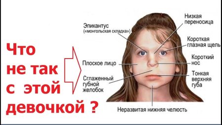 Фетальный алкогольный синдром у Натальи Водяновой