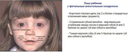 ФАС фетальный алкогольный синдром