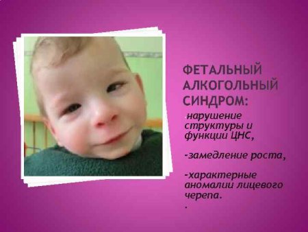 Atnfkфетальный алкогольный синдром