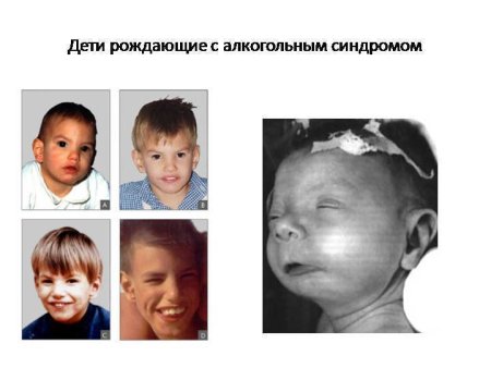 Алкогольный синдром у детей