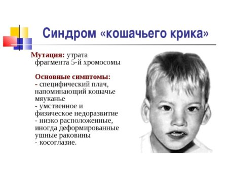 Синдром Шерешевского Тернера кошачьего крика