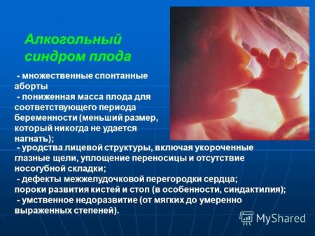 Алкогольный синдром плода