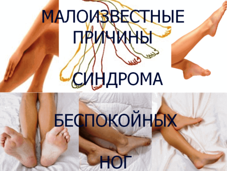 Синдром беспокойных ног