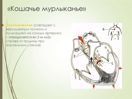 Кошачье мурлыканье при аортальном стенозе