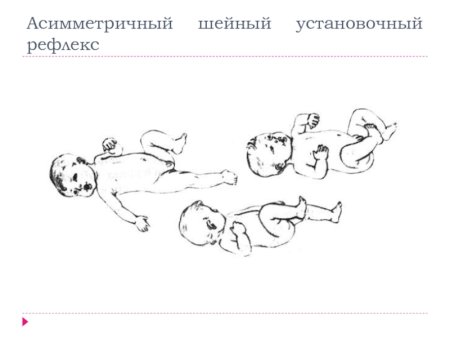 Установочный шейно тонический рефлекс