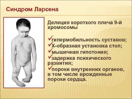 Синдром дупликации короткого плеча хромосомы 9