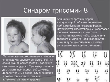 Синдром Дауна трисомия
