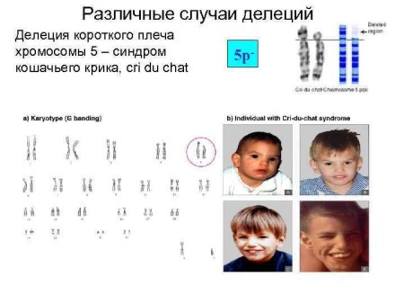 Делеция 5 хромосомы синдром кошачьего крика