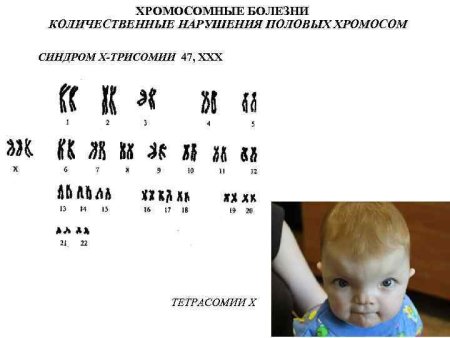 Синдром Эдвардса кариотип болезни