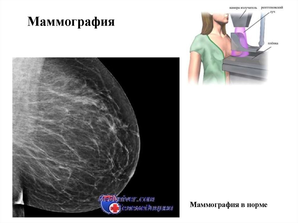 Маммография ростов на дону. Маммограмма молочных желез норма. Норма молочной железы маммограмма. Маммография молочной железы норма у женщин. Маммография молочной железы снимки норма.