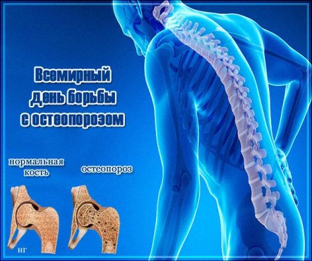 День остеопороза