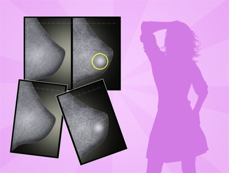 Маммография иллюстрация