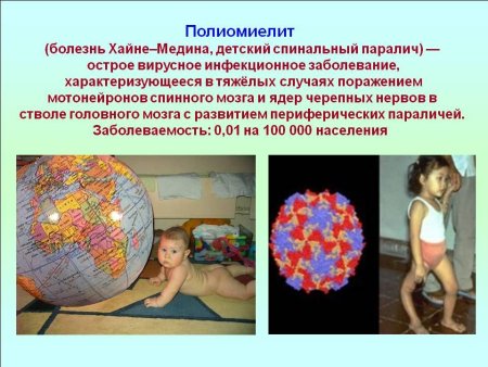 Вирусные заболевания полиомиелит