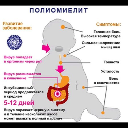 Клинические симптомы полиомиелита