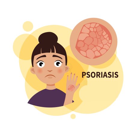 Псориаз инфографика