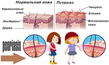 Памятка по профилактике псориаза